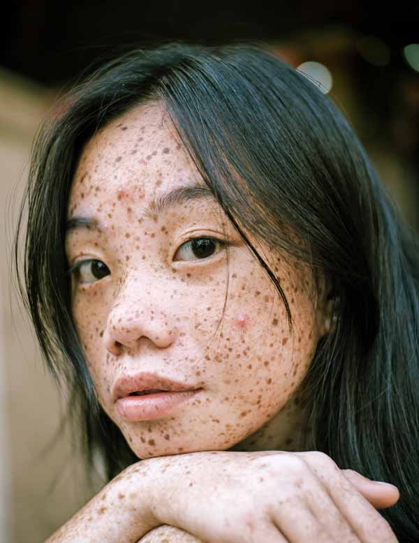 Chica con lentigos en la piel